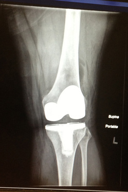 knee pain arthritis