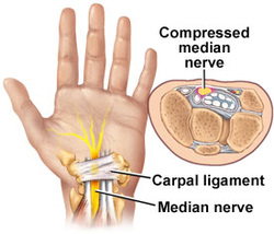 Chiropractic manipulation helps reduce the pressure causing carpal tunnel pain